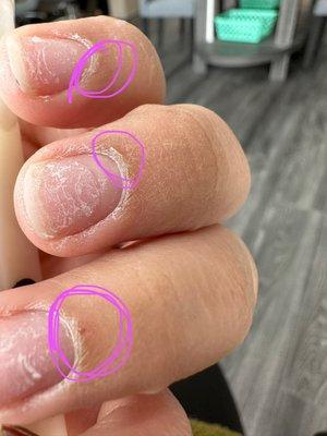 Hurt cuticles