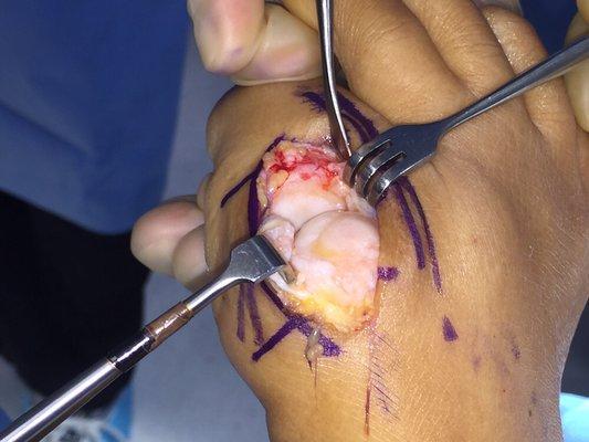 Arthritis in great toe joint. A.k.a. Hallux limitus.  Performing cheilectomy procedure.