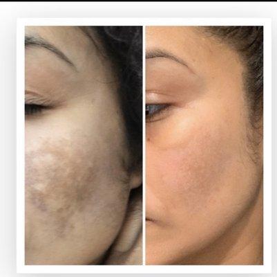 Chemical Peel 
3 sessions 
1 Melaspeel 
1 TCA ( focal application)
1 Melaspeel 
Results after 3rd Treatment