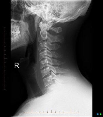 Cervical spine xray