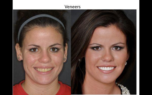 SMILE MAKEOVER
 Sarasota Florida