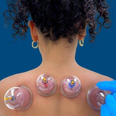 Cupping at A Plus Acupuncture & Massage Therapy located at 1300 Union Tpke #103A, in 
North New Hyde Park, NY.