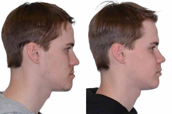 Corrective Jaw Surgery Results