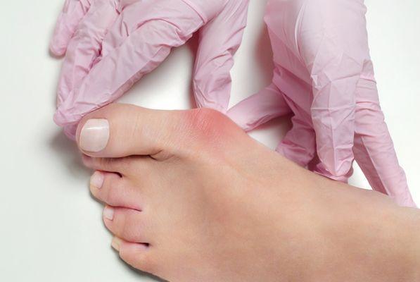 Bunion consultation-evaluating surgery versus conservative care to meet your needs.  For more information visit our website Onyourfeetaz.com