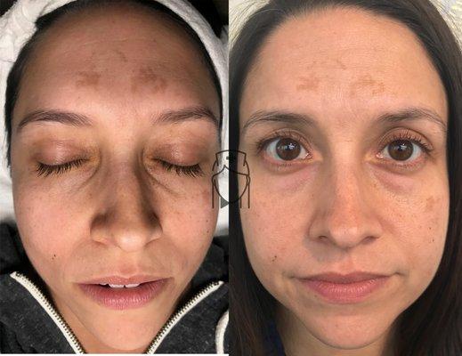 After only 1 Vi Peel.  Melasma is decreased by 50%