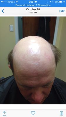 Before men's hair restoration