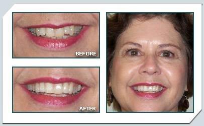 By treating only two teeth, and whitening, smile is drastically improved.