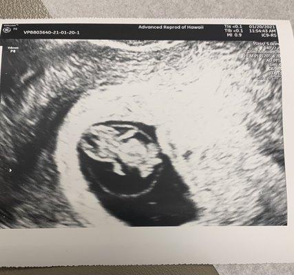 9 weeks ultrasound