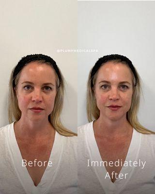 Liquid facelift