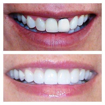 Y.C. After just 4 veneers