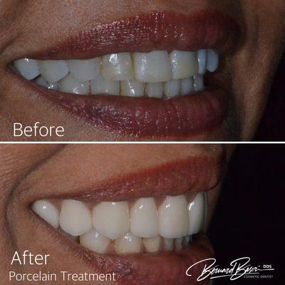 Porcelain Veneer Dentist, Cosmetic Dentist, affordable dental treatment