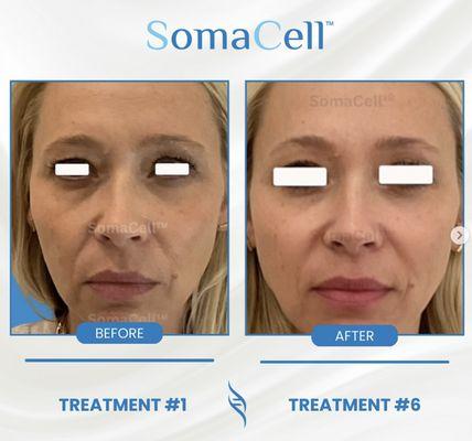 SomaCell(tm) non-invasive