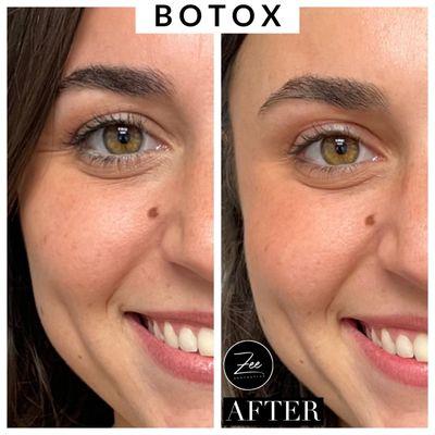 Botox Eye Opener