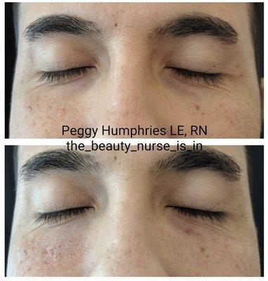 HA Filler to restore Tear Trough depletion