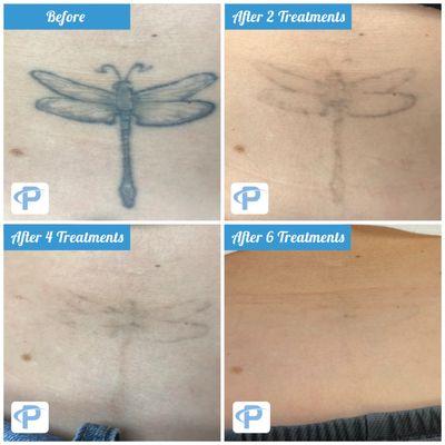 Premium Tattoo Removal