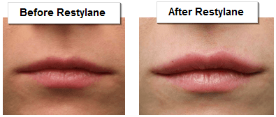 Before and After Restylane Treatment