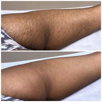 Amazing results with waxing hair removal!