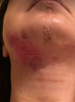 Huge scar after surgery