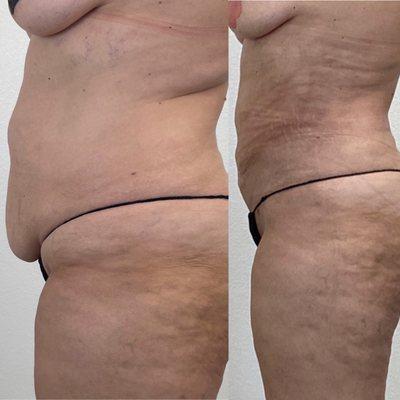 Liposuction