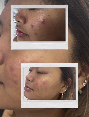 Results after just one Facial Treatment