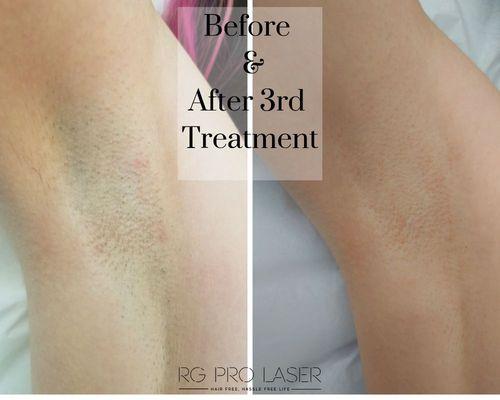 Underarm hair removal!