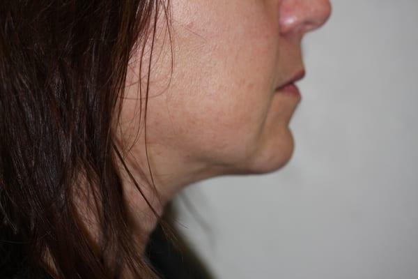 This is the "after" photo of my neck, a short while after the liposuction performed by Dr. Denkler. I still look the same!