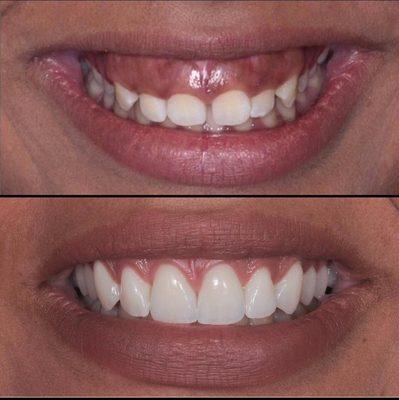 Laser gum lift and porcelain veneers