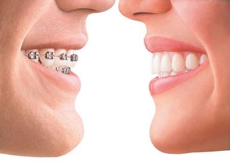 metal braces and Invisalign