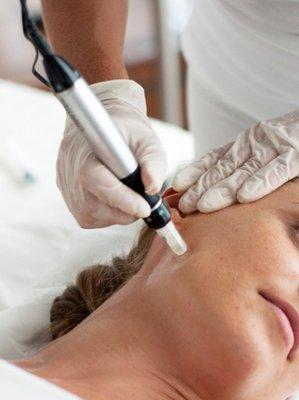 Micro Needling