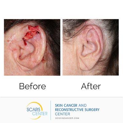 Skin Cancer Reconstruction of Ear