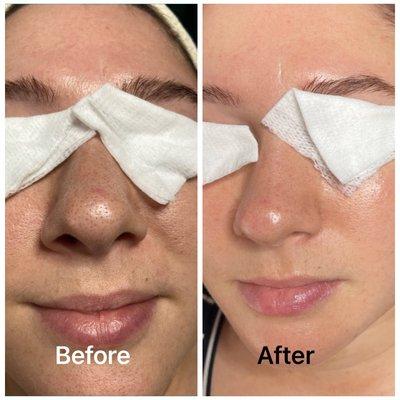 Deep pore cleansing facial!