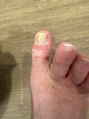 BAD Fungal infection acquired from nail salon‼