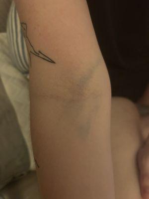 Another bruise from blown out veins :)