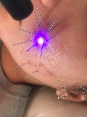 Blue Light Facial Acupuncture.