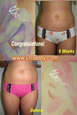 Female Liposuction Tummy & Inner Thighs - Before and After