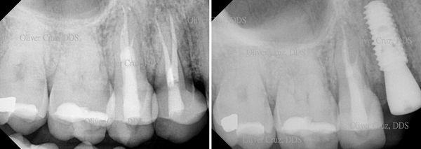 A fractured tooth removed and replaced with an implant, one visit appointment.