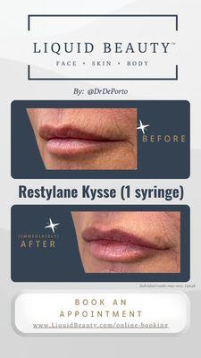 Restylane Kysse lip filler augmentation at Liquid Beauty Temecula by Dr. DePorto MD.