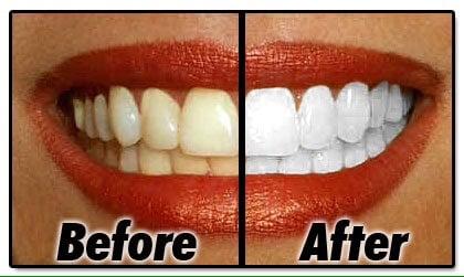 Your teeth could get up to 12 shades whiter in less than hour