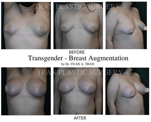 Here's a before and after picture of a transgender patient who underwent breast augmentation.