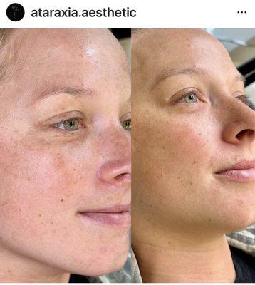 Before & After Dermaplane