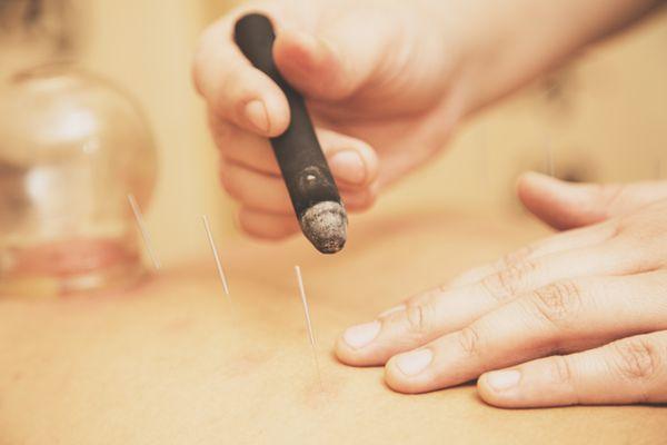 Jackie using moxibustion therapy in conjunction with acupuncture to treat digestive issues.