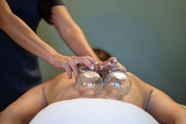 Cupping therapy at Carolina Family Acupuncture- Greenville