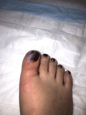 After having my ingrown toenail removed.