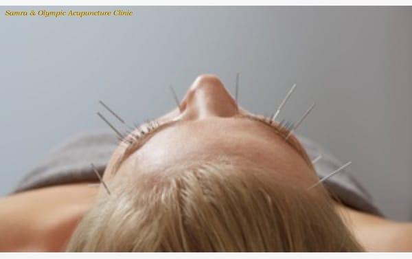 Acupuncture treatment for Facial