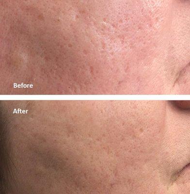 Laser Acne Scar Removal- 1 Treatment Session