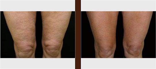 Cellulite reduction (thigh)