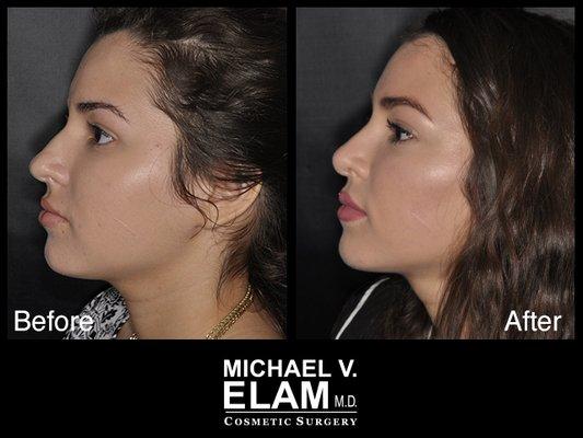 Rhinoplasty - 1 Year Post Op - 22 Year Old Woman