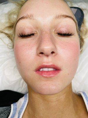 Microneedling for natural lip Enhancement