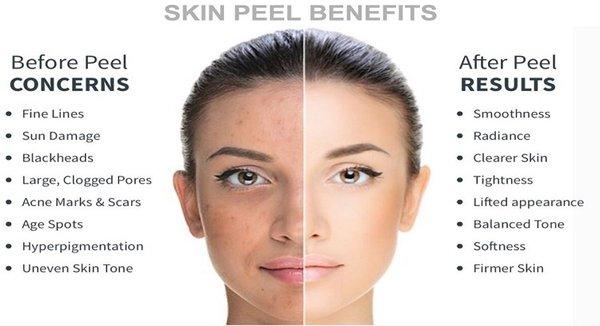 Skin peel treatment for first visit get 20% off.appointment only call:469-904-8131