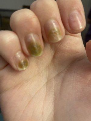 infected nails